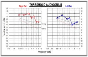 Audiogram